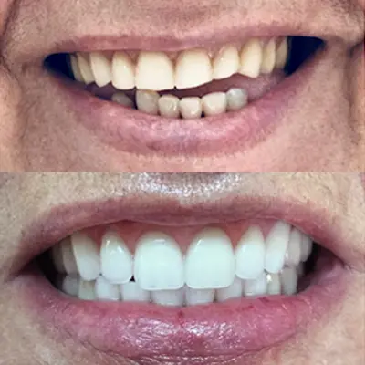 foto ilustrativa Clareamento Dental